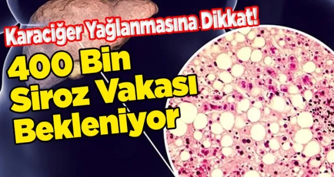 Karaciğer Yağlanmasına Dikkat!